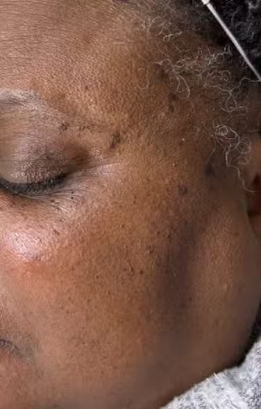 Before Image: DPN before after with laser vs Hyfrecation - left-side
