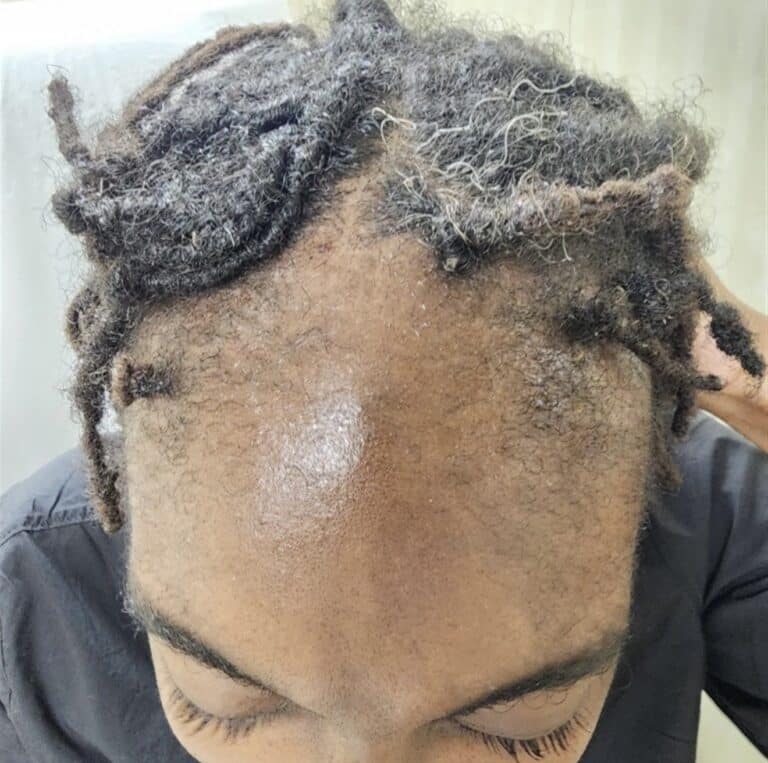 Before Image: Traction Alopecia Before and After - front