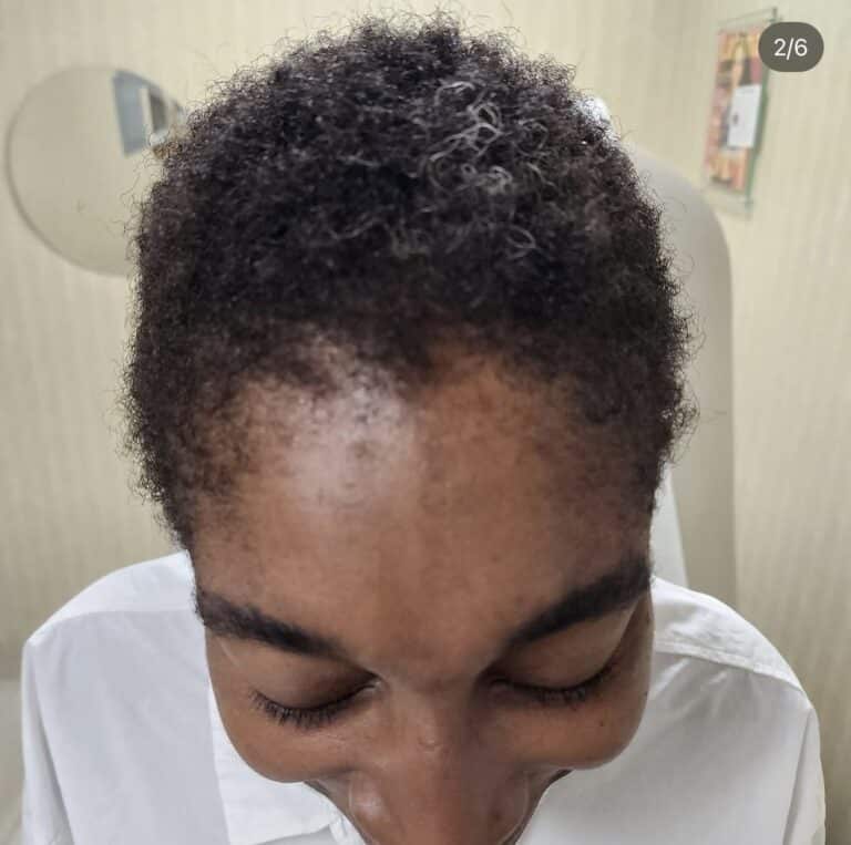 After Image: Traction Alopecia Before and After - front