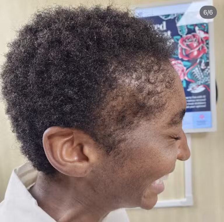 After Image: Traction Alopecia - right-side