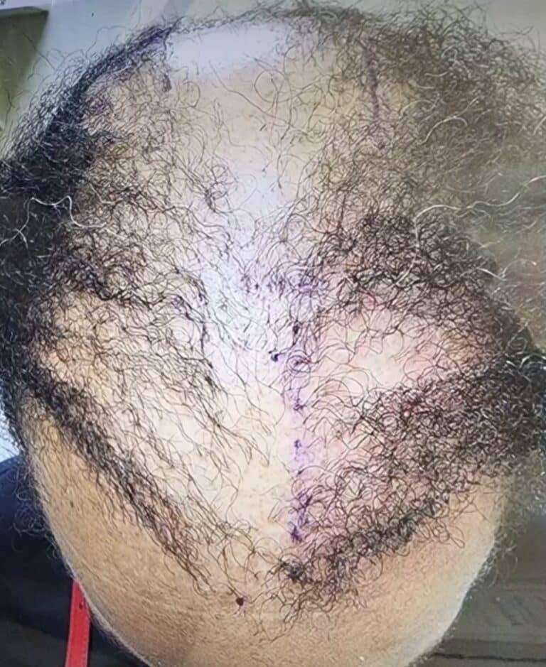 Before Image: Non compliant patient: Alma TED - front