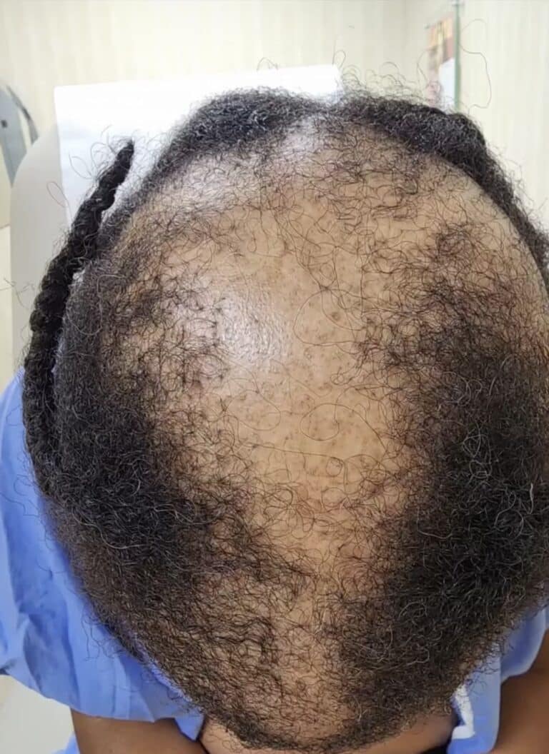 After Image: Non compliant patient: Alma TED - front