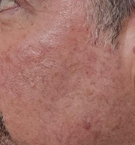 laser for rosacea as depicted by blood vessels under skin
