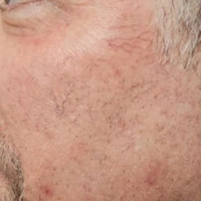 laser for rosacea as depicted by a man's cheek before treatment