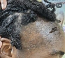 do protective hairstyles cause hairloss as depicted by traction alopecia on frontal hairline